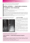 Научная статья на тему 'Limbus vertebra — отделение сегмента от апофиза тела позвонка'
