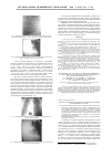 Научная статья на тему 'Способ аутогемотрансфузии при эндопротезировании тазобедренного сустава'