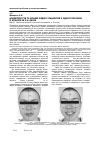 Научная статья на тему 'Асиметрія губ та зубних рядів у пацієнтів з одностороннім ІІ класом за E. H. angle'