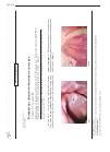 Научная статья на тему 'Бляшки на слизистой оболочке полости рта'