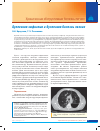 Научная статья на тему 'Буллезная эмфизема и буллезная болезнь легких'