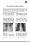 Научная статья на тему 'Churg-Straus syndrome in rheumatologists practice'