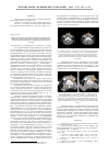 Научная статья на тему 'Диагностическое значение мультиспиральной рентгеновской компьютерной томографии для контроля результатов дистанционной лучевой терапии при раке гортани'