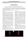 Научная статья на тему 'Эффективность МСКТ ангиографии при аневризмах инфраренального отдела аорты'