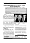 Научная статья на тему 'Finite element analyses of firing behavior of Metalceramic crown margins'