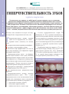 Научная статья на тему 'Гиперчувствительность зубов у детей и подростков'