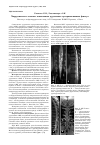 Научная статья на тему 'Хирургическое лечение спинальных дуральных артериовенозных фистул'