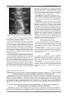 Научная статья на тему 'Изменение плотности костной ткани при лечении ложных суставов голени методом чрескостного компрессионного остеосинтеза'