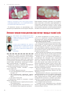 Научная статья на тему 'Лечение гиперестезии дентина при потере твердых тканей зуба'