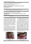 Научная статья на тему 'Лечение перелома корней постоянных зубов у ребенка (клинический случай)'