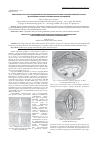 Научная статья на тему 'Локальная пластика рецидивной послеоперационной грыжи передней брюшной стенки (длительные клинико-анатомические наблюдения)'