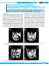 Научная статья на тему 'Магнито-резонансная томография как метод распознавания ранних проявлений деформирующего остеоартроза коленных суставов'