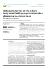 Научная статья на тему 'Metastatic tumor of the ciliary body manifesting as phacomorphic glaucoma: A clinical case'