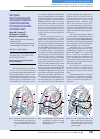 Научная статья на тему 'Методика экстраторакальной фиксации переднего реберного клапана при множественном переломе ребер'