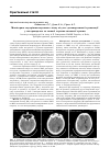 Научная статья на тему 'Мониторинг внутричерепного давления при декомпрессивной трепанации у пострадавших при тяжелой черепно-мозговой травме'