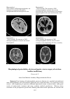 Научная статья на тему 'Morphological potentialities of external jugular vein in surgery of vertebro-basillar insufficiency'