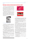 Научная статья на тему 'Некоторые аспекты лечения кариеса временных зубов'