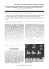 Научная статья на тему 'Новый интраоперационный метод определения оптимальной позиции правожелудочкового электрода при имплантации постоянного электрокардиостимулятора'