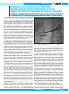 Научная статья на тему 'Новый метод лечения резистентной артериальной гипертензии посредством симпатической денервации почечных артерий'