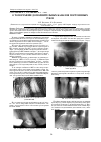 Научная статья на тему 'О топографии дополнительных каналов постоянных зубов'