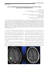 Научная статья на тему 'Опыт эффективного использования гамма-ножа при лечении метастазов в головном мозге'