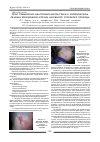 Научная статья на тему 'Опыт применения меатотимпанопластики в хирургическом лечении врожденной атрезии наружного слухового прохода'