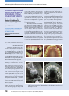 Научная статья на тему 'Особенности дентальной имплантации в области фронтальной группы зубов верхней челюсти'