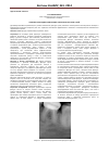 Научная статья на тему 'Особенности методики герметизации открытых фиссур зубов у детей'