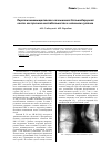 Научная статья на тему 'Перелом межмыщелкового возвышения большеберцовой кости как причина нестабильности в коленном суставе'