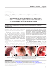 Научная статья на тему 'Пероральная эндоскопическая миотомия при ахалазии кардии: интраоперационные осложнения и методы их коррекции'