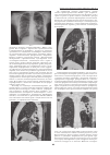 Научная статья на тему 'Персонифицированный подход к дифференциальной диагностике туберкулёза лёгких и двухсторонней пневмонии атипичной локализации'