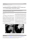 Научная статья на тему 'Первый опыт выполнения торакоскопических лобэктомий с бронхопластикой'
