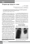 Научная статья на тему 'Плевриты при туберкулезе легких'