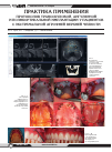 Научная статья на тему 'Практика применения протоколов транс-скуловой, ангулярной и поликортикальной имплантации у пациентов с экстремальной атрофией верхней челюсти'