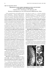 Научная статья на тему 'Применение межтелового корпородеза после дискэктомии в грудном отделе позвоночника'