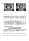 Научная статья на тему 'Применение ультразвуковой системы «VECTOR» в лечении пациентов с хроническим генерализованным пародонтитом'