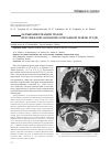 Научная статья на тему 'Разрыв бифуркации трахеи при тяжелой закрытой сочетанной травме груди'