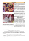 Научная статья на тему 'Редкий случай эндокардита Леффлера как проявление эозинофильного гранулематоза с полиангиитом'