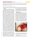 Научная статья на тему 'Реконструктивно-пластическая хирургия рака молочной железы центральной и медиальной локализации'