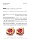 Научная статья на тему 'Ректоцеле: клинические проявления и хирургическая коррекция'