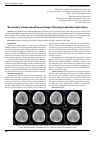 Научная статья на тему 'Secondary intracerebral hemorrhage following traumatic brain injury'