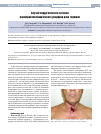 Научная статья на тему 'Случай хирургического лечения паратрахеостомического рецидива рака гортани'