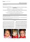 Научная статья на тему 'Современное представление об акроцефалосиндактилии у детей (по данным литературы)'