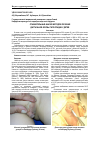 Научная статья на тему 'Сравнительный анализ методов лечения дистальной формы гипоспадии у детей'