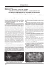Научная статья на тему 'Surgery of lower wisdom teeth – consequences for the amount of bone near the adjoining second molar'