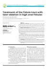 Научная статья на тему 'Treatment of the fistula tract with laser ablation in high anal fistulas'