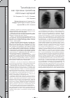 Научная статья на тему 'Тромбофилия как причина тромбоза лёгочных артерий'