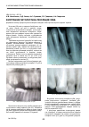Научная статья на тему 'Внутрішня патологічна резорбція зуба'