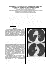 Научная статья на тему 'Возможности текстурного анализа компьютерных томограмм в диагностике хронической обструктивной болезни'