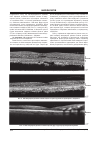 Научная статья на тему 'Зміни морфології сітківки в залежності від виду лікування набряку макулярної ділянки після факоемульсифікації катаракти'